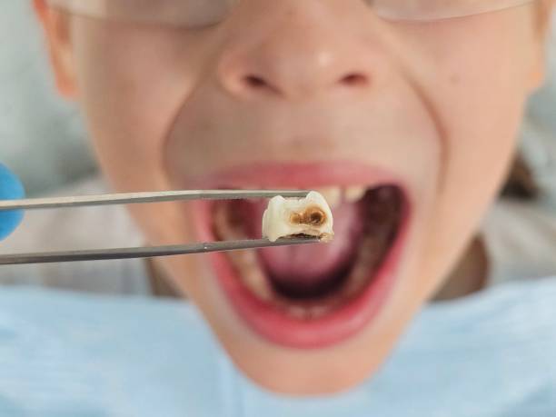Best Dentist for Tooth Abscess  in Marienville, PA